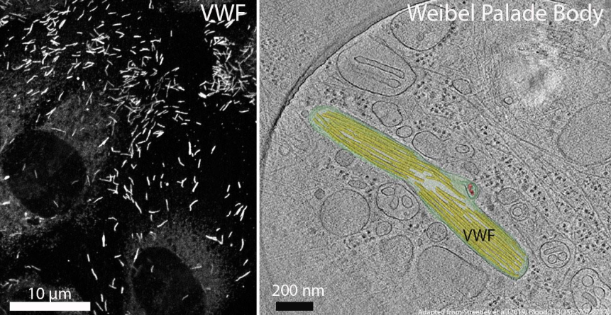 MAAD variant study - VWF and Weibel Palade