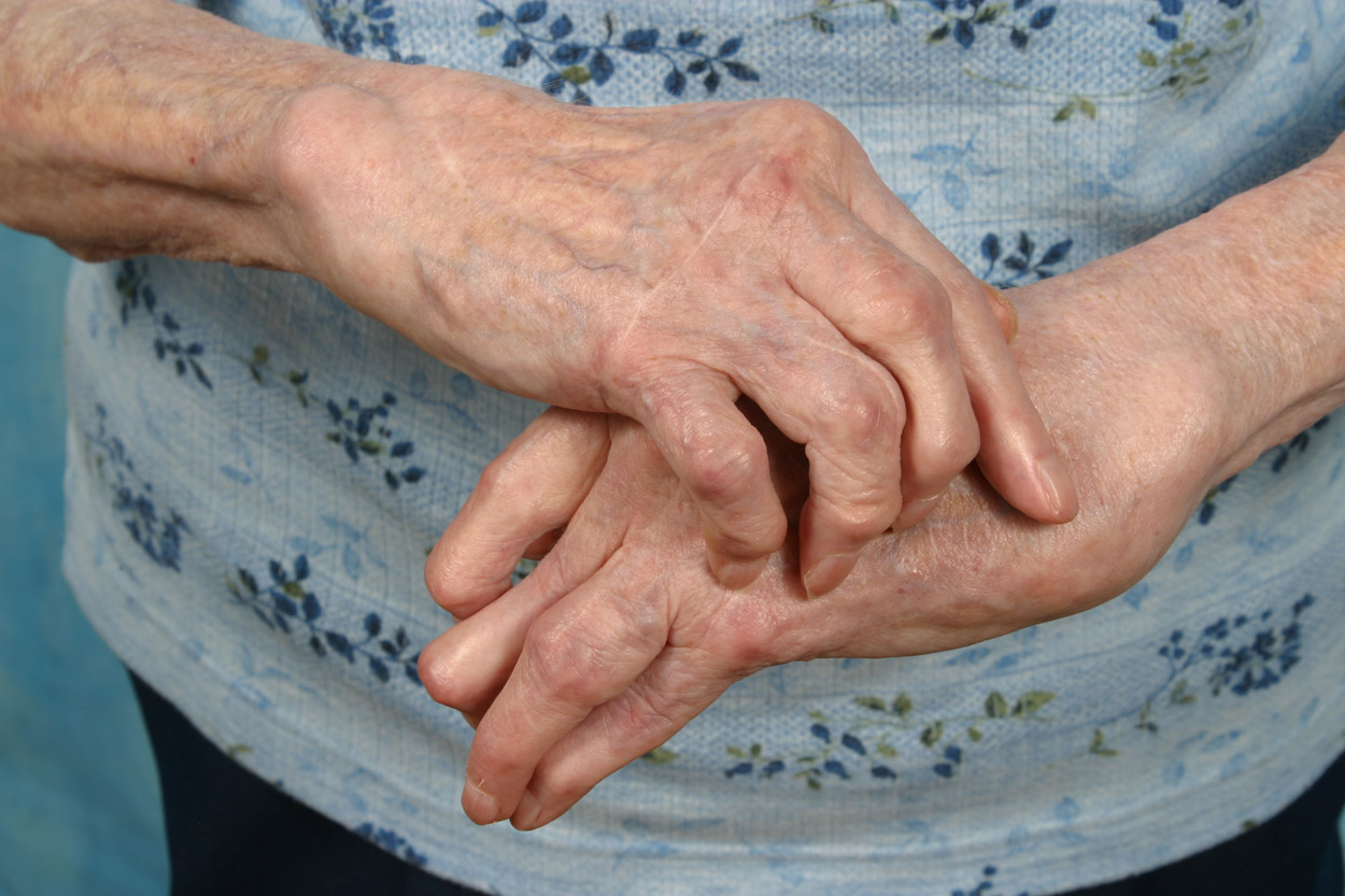 arthritis_hands_rs