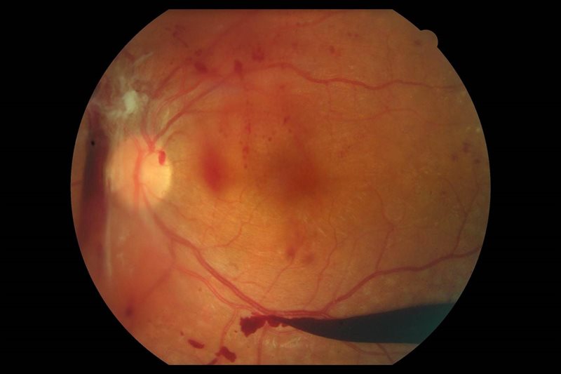 An image of the back of an eye showing signs of diabetic retinopathy.