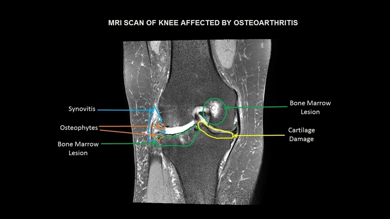 An MRI scan of a knee affected by osteoarthritis.